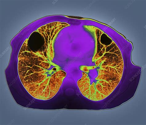 Lung Abscess Ct Scan Stock Image C0095380 Science Photo Library