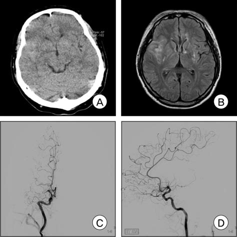 Initial Brain Ct Magnetic Resonance Imaging Mri And Dsa On