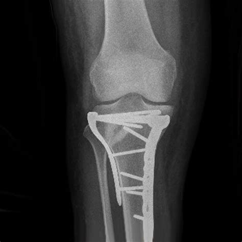 Lower Limb Fractures