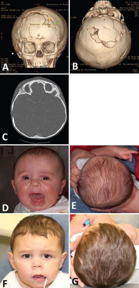 Reconstruction Of Unicoronal Plagiocephaly With A Hypercorrection