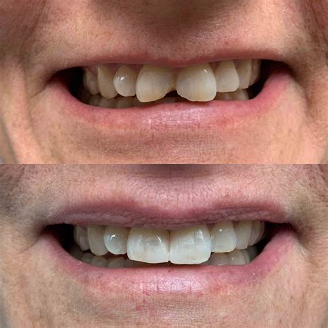 How Do Dentist Fill Cavities Between Teeth