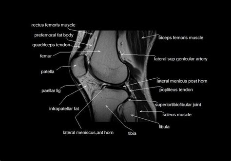 Knee Mri Anatomy Related Keywords And Suggestions Knee Mri Anatomy Long