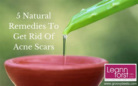 5 Natural Remedies To Get Rid Of Acne Scars Leann Forst