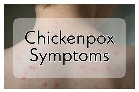 Pin On Chickenpox Symptoms
