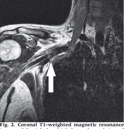 Figure 2 From Neurogenic Thoracic Outlet Syndrome Caused By Subacute