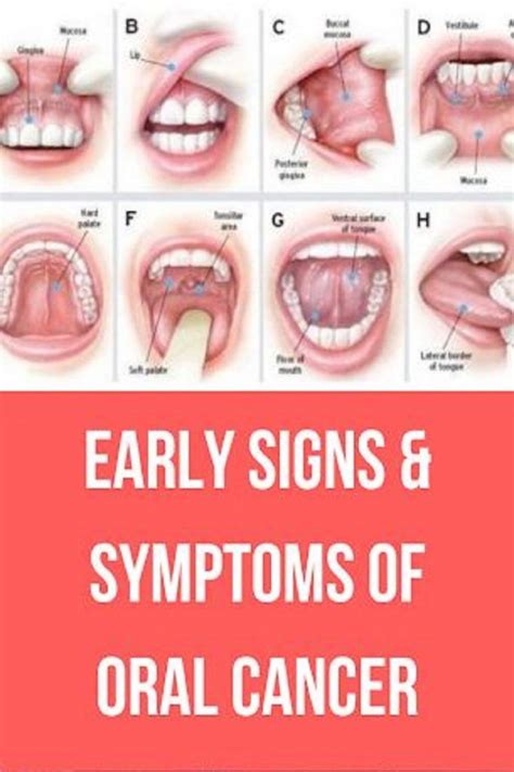 The truth is that early stage cancers are often painless! Early Signs & Symptoms of Oral Cancer | Wellness Global