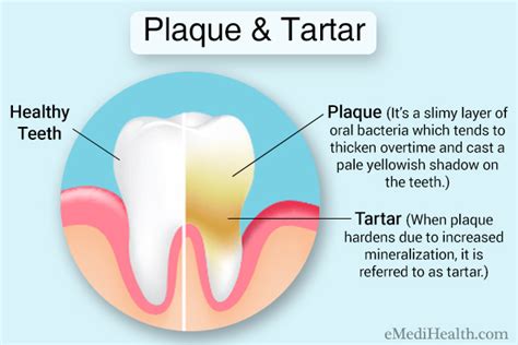 how to remove plaque and tartar buildup emedihealth