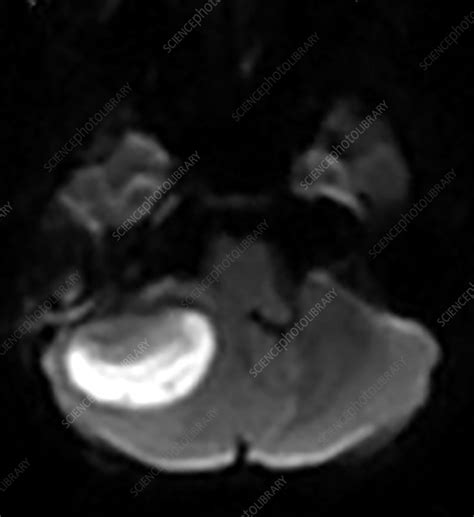 Cerebellar Abscess Secondary To Mastoiditis Stock Image C0435594