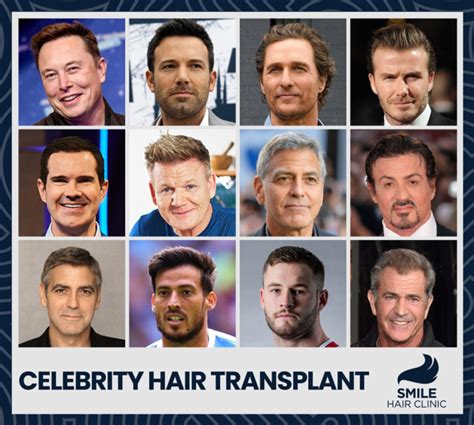Celebrities Hair Transplants Smile Hair Clinic