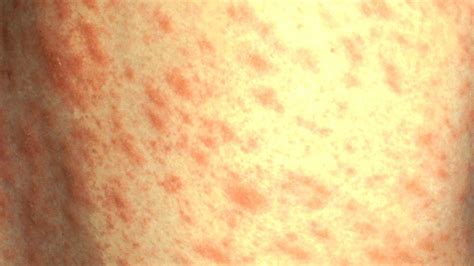 Is That Rash Psoriasis Psoriasis Pictures And More Everyday Health