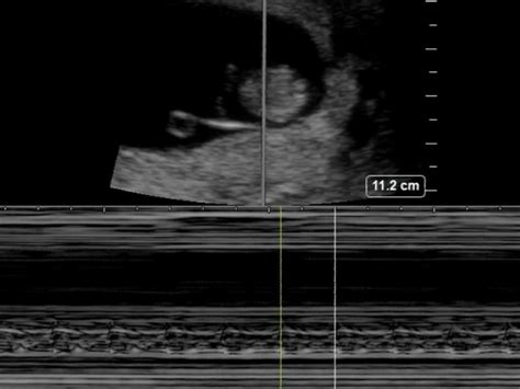 Subchorionic Bleed10 Week Pregnancy Critical Care Sonography