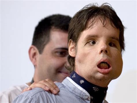 Photos Of The Worlds First Full Face Transplant · The Daily Edge