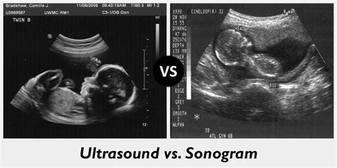 Difference Between Ultrasound And Sonogram Renew Physical Therapy