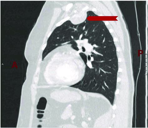 A Sagittal Plane Of The Ct Scan Of Chest Showing A Smooth Well Defined