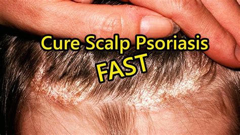 Scalp Psoriasis Home Remedies How To Cure Scalp Psoriasis Fast Youtube