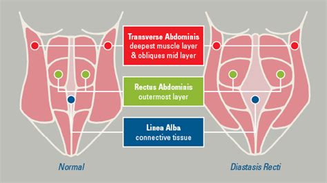 Causes And Treatments Of Diastasis Recti Among Men New Health Advisor