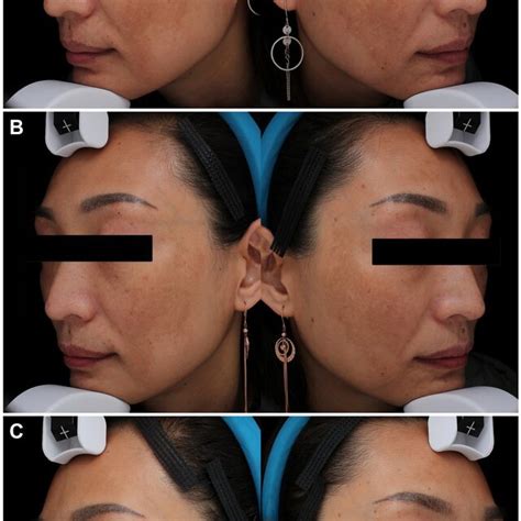 Melasma In A 41 Year Old Woman With Fitzpatrick Skin Type Iv In The