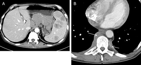 Two Patients With Radiological Extranodal Involvement A A Patient With