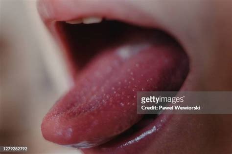 Scarlet Fever Tongue Fotografías E Imágenes De Stock Getty Images