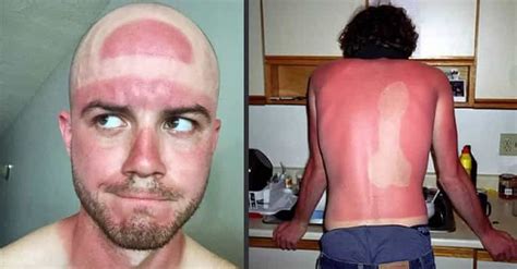 Worst Sunburn Photos 54 Epic And Painful Sunburns