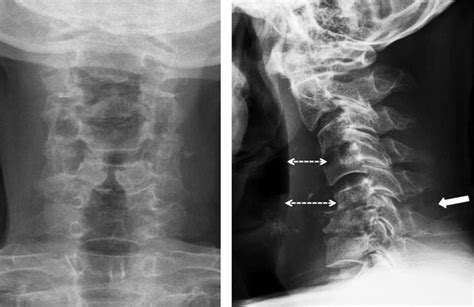 Anteroposterior A And Lateral B Views Of The Cervical Spine Show