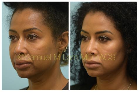 this african american woman is shown before and 5 months after upper and lower lip reduction to