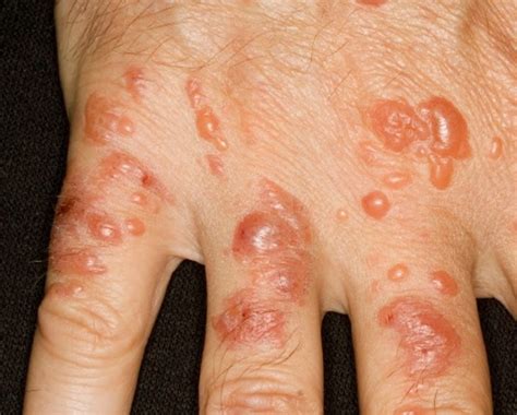 What Is The Difference Between Contact And Allergic Dermatitis Atopic