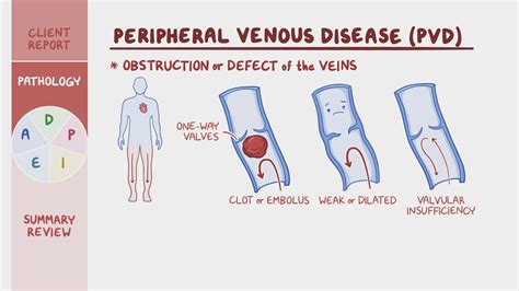 Peripheral Venous Disease Pvd Nursing Process Adpie Osmosis