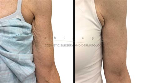 Injectable Fillers Chicago Cosmetic Surgery And Dermatology