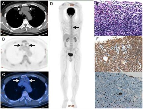 Frontiers Thymic Extranodal Marginal Zone Lymphoma Of Mucosa