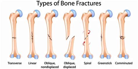 Long Bone Anatomy Structure Parts Function And Fracture Types