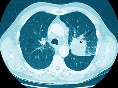 Brits Up Cancer Screening With Mobile Lung Ct Units