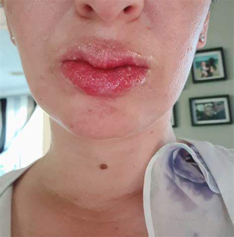 Please Help Tiny Bumps Blisters On Lips Day 15 Of Accutane