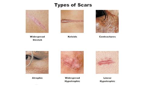 How To Get Rid Of Scars Skin Beauty
