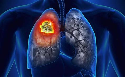 Carcinoid Tumor Lung Prognosis Symptoms And Treatment Canceroz