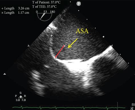 Tee Detection Of A Pfo A The Left Pfo Height And Pfo Tunnel Length