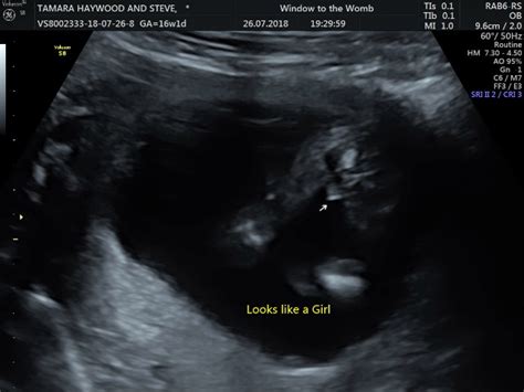 16 Week Gender Scan Help Glow Community