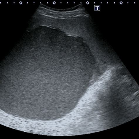 A Axial Image Of Non Contrast Ct Abdomen Shows The Large Splenic Cyst