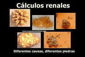 En Cualquier Momento Eficacia Ansiedad Tipos De Calculos Renales