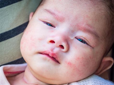 婴儿湿疹的诊断治疗研究进展 爱爱医医学网