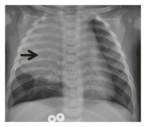 Chest X Ray Rul Infiltration And Enlarged Intercostal Space In Level