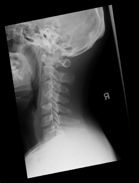 Postoperative Radiograph Showing Solid Fusion Of C3 And C4 Vertebrae