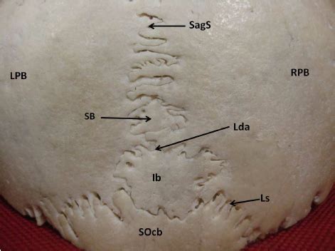 Fori del cranio umano (fra cui foro giugulare, foro ovale, foro occipitale, foro rotondo, meato acustico) · coane · cavità orbitale · cavità nasale: Showing a single interparietal bone.SagS- Sagital suture ...