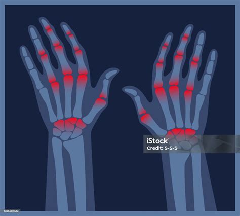 Arthritis Hands Xray Pain In The Human Body Arthritis Bone Disease
