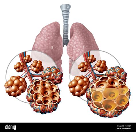 Pneumonia In The Lungs And Pulmonary Alveoli With Fluid Or Alveolus