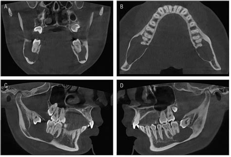 Bilateral Mandibular Dentigerous Cysts In A Non Syndromic Patient