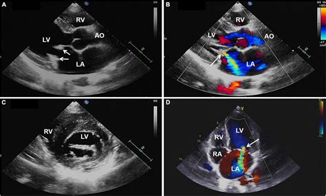 Frontiers Case Report Mitral Valve Replacement For Libman Sacks