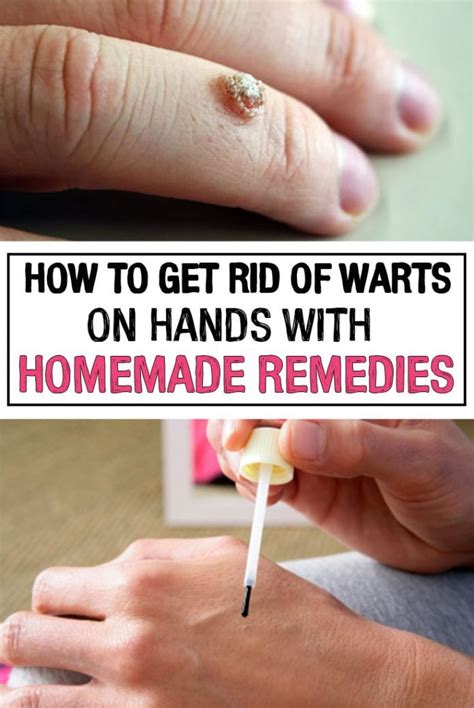 How To Get Rid Of Warts On Hands With Homemade Remedies Iwomenhacks