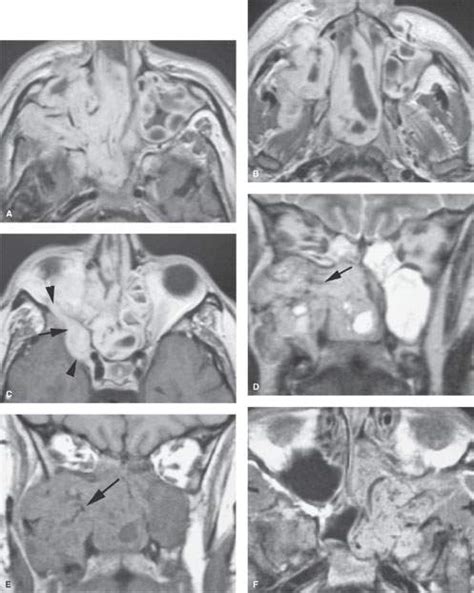 Nasopharynx Juvenile Angiofibroma Radiology Key