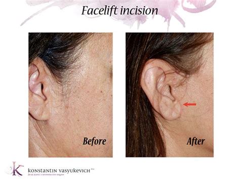 The Evolution Of Facelift Incisions Manhattan Nyc Specialist Konstantin Vasyukevich Md